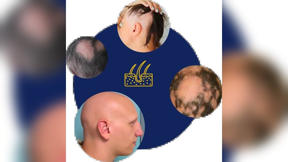 Autoimmune Hair Loss Conditions: Alopecia Areata Explained Autoimmune Hair Loss Conditions: Alopecia Areata Explained