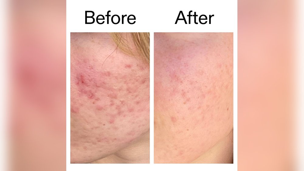 Azelaic Acid And Barrier Health: Gentle Active for Sensitive Skin Azelaic Acid And Barrier Health: Gentle Active for Sensitive Skin
