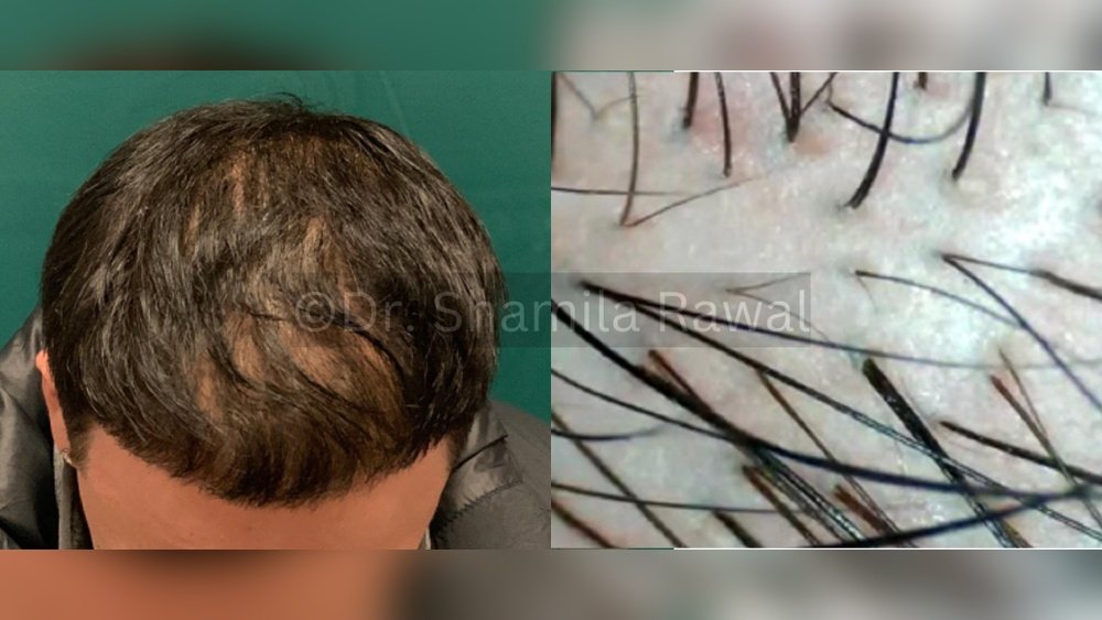 Chronic Telogen Effluvium: When Hair Shedding Lasts More Than 6 Months