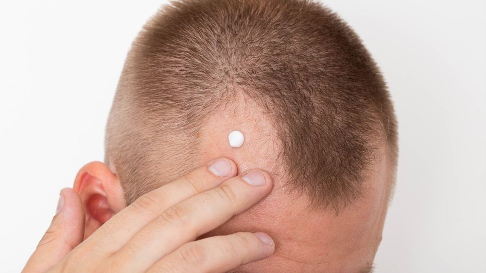 Exosome Therapy for Hair Loss: The Cutting-Edge 2026 Treatment Exosome Therapy for Hair Loss: The Cutting-Edge 2026 Treatment