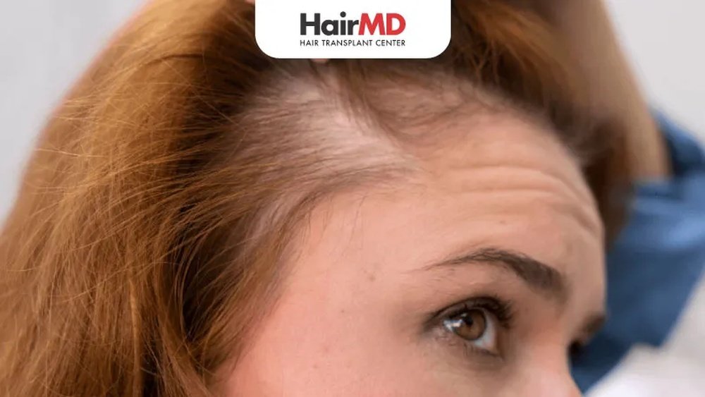Frontal Fibrosing Alopecia in Women: Early Signs And Management
