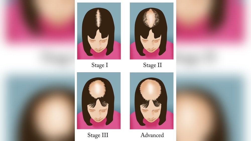 Hair Loss Journal: How to Monitor Shedding Patterns Over Time