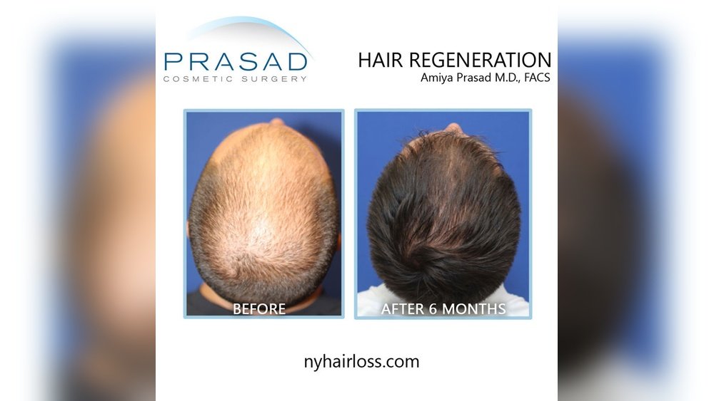 Hair Transplant Alternatives for Women: Non-Surgical Options Compared