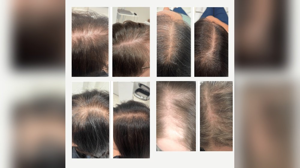 Hormone Replacement Therapy And Hair Loss: Does Hrt Help Or Hurt