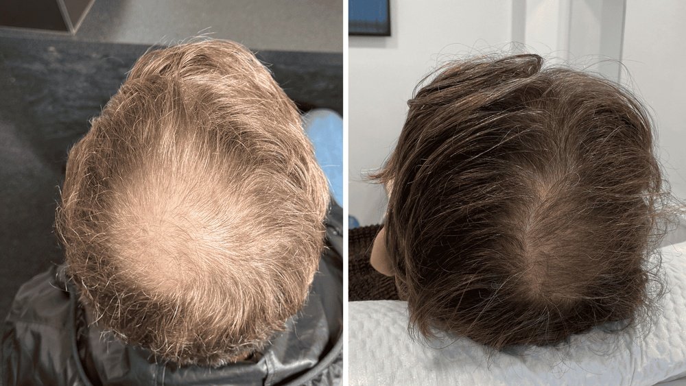 How to Track Hair Regrowth Progress: Photo Documentation Guide How to Track Hair Regrowth Progress: Photo Documentation Guide