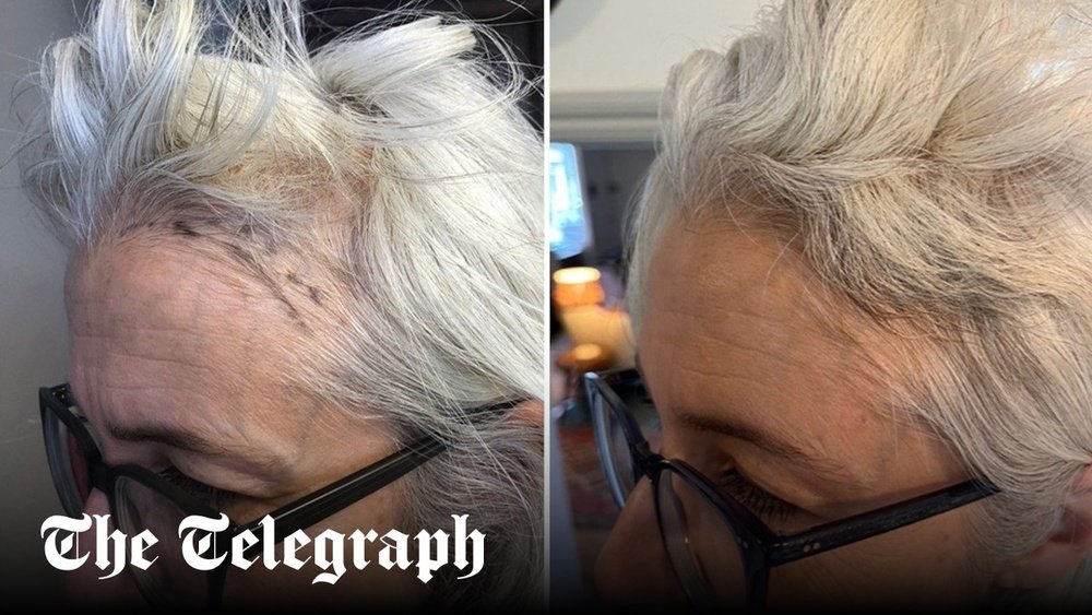Iron And Ferritin Deficiency Hair Thinning in Midlife Women Iron And Ferritin Deficiency Hair Thinning in Midlife Women