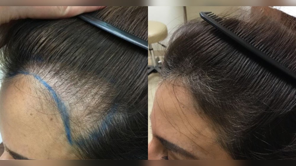 Platelet-Rich Plasma Prp for Female Hair Loss: Is It Worth the Cost Platelet-Rich Plasma Prp for Female Hair Loss: Is It Worth the Cost