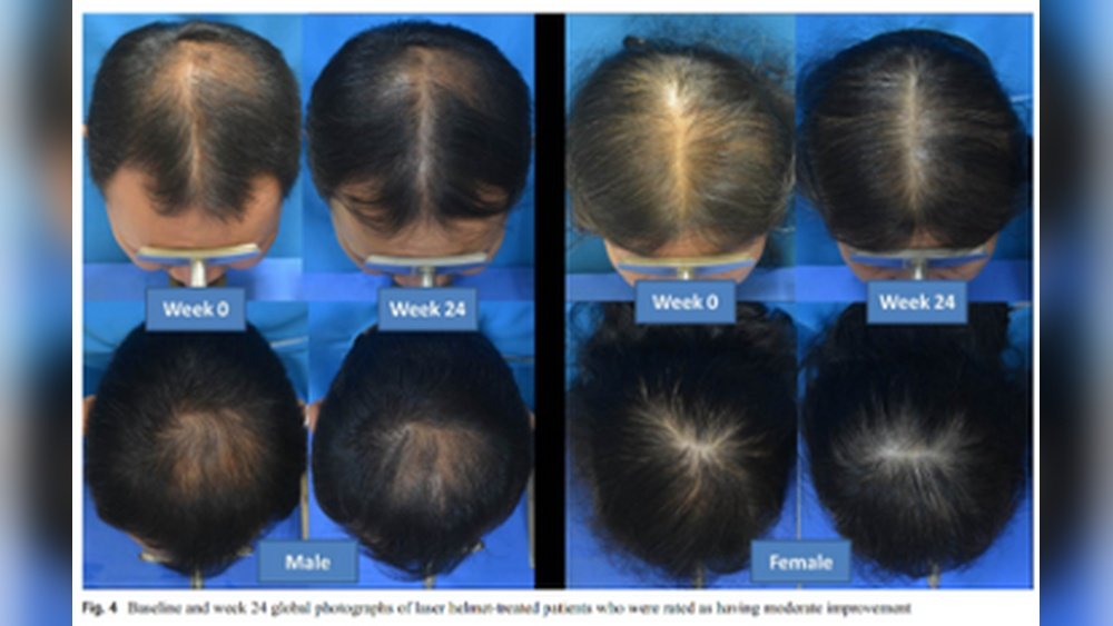 Red Light Therapy Caps for Hair Regrowth: Do They Actually Work Red Light Therapy Caps for Hair Regrowth: Do They Actually Work