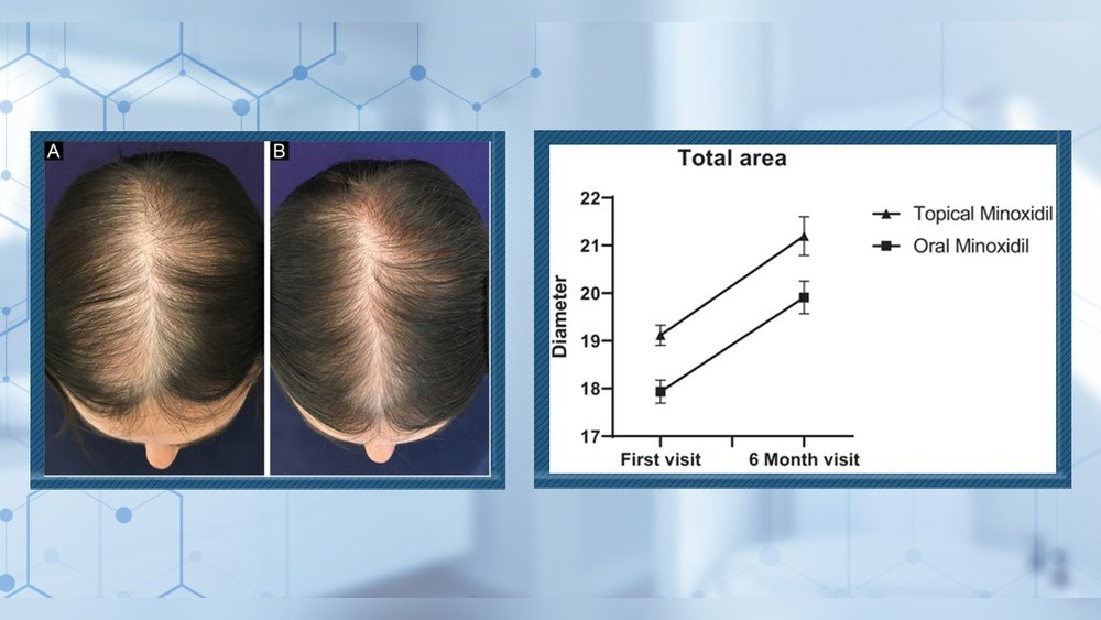 Saw Palmetto Dosage for Hair Loss: Oral Vs Topical Comparison Saw Palmetto Dosage for Hair Loss: Oral Vs Topical Comparison
