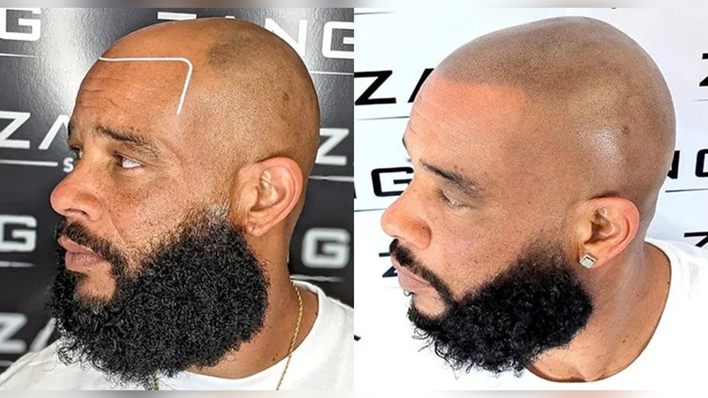 Scalp Micropigmentation: Everything You Need to Know Before Committing