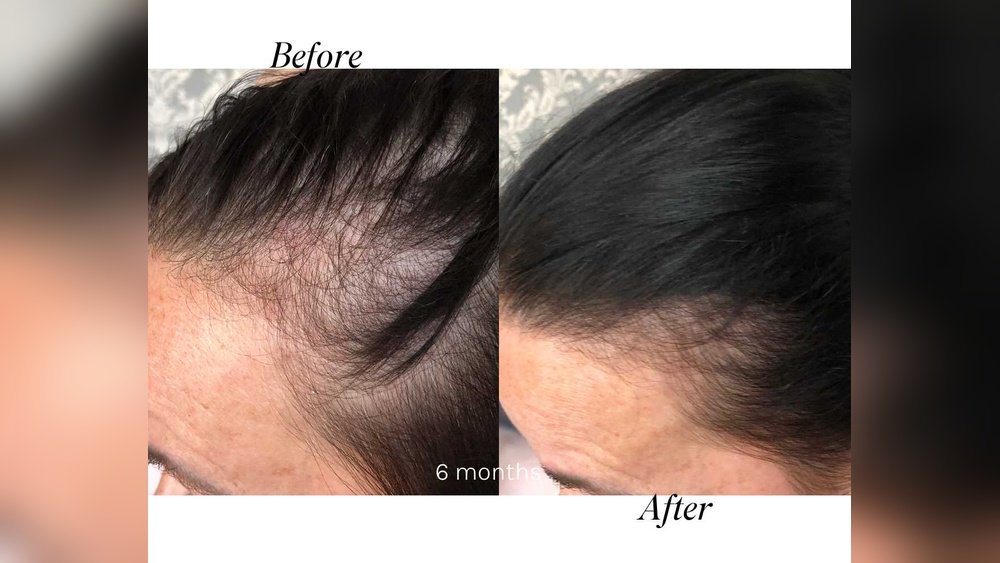 Stress-Induced Hair Loss: How Cortisol Attacks Your Hair Follicles