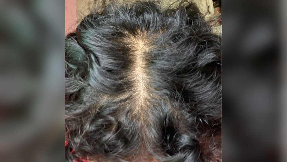 Telogen Effluvium Vs Androgenetic Alopecia: How to Know Which You Have Telogen Effluvium Vs Androgenetic Alopecia: How to Know Which You Have